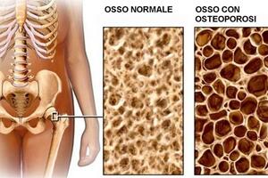 Osteoporosi: cosa sapere e come prevenirla – un evento ieri (28 aprile) a Carrara con oltre 30 valutazioni sui cittadini